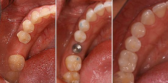 Ingrijirea implanturilor dentare﻿