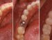 Ce sunt implanturile dentare si ﻿cat de reusite sunt?