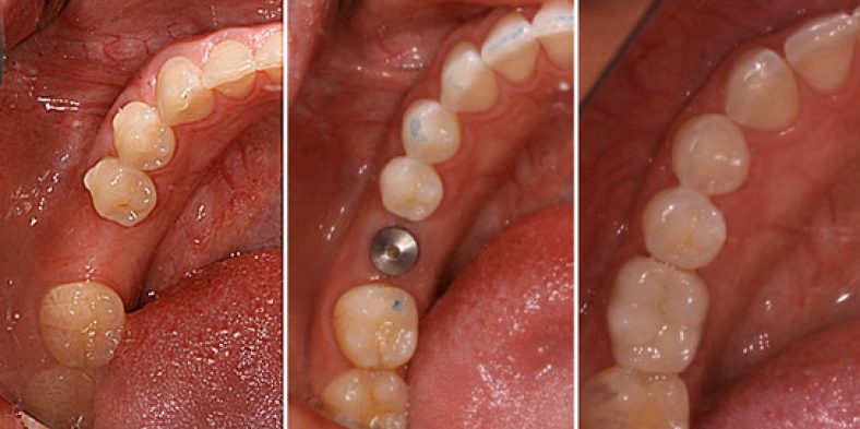 Ce sunt implanturile dentare si ﻿cat de reusite sunt?